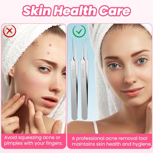 3 stuks Blackhead Verwijdering Tweezers Set, Pimple Remover Set, Tweezers voor het verwijderen van ingegroeid haar, roestvrij staal, Blackhead Extractor voor Acne 5